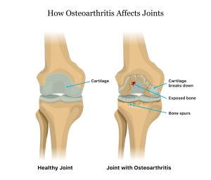 Arthritis-Pain-Relief-Causes