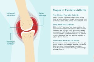 Psoriatic-Arthritis-Pain-Relief
