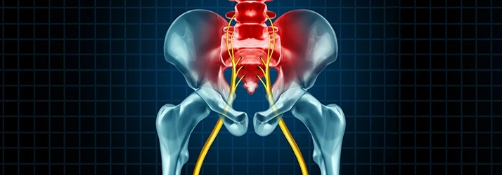 Sciatic Pain Diagram 3D Model Of the Hips